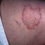 Ringworm on an Older Person