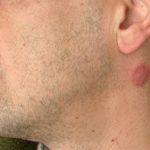 Ring worm on a Man's Neck