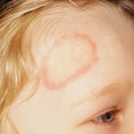 Ringworm on Kid's forehead