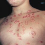Ringworm on Kid's Chest